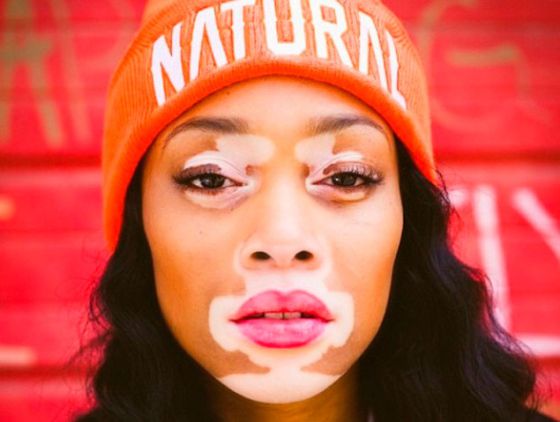 A modelo que levou o vitiligo à passarela