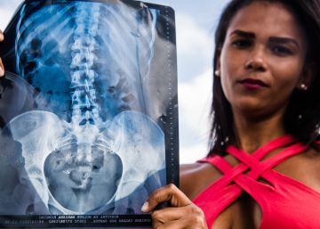 As vítimas de um implante da Bayer que prometia esterilização
