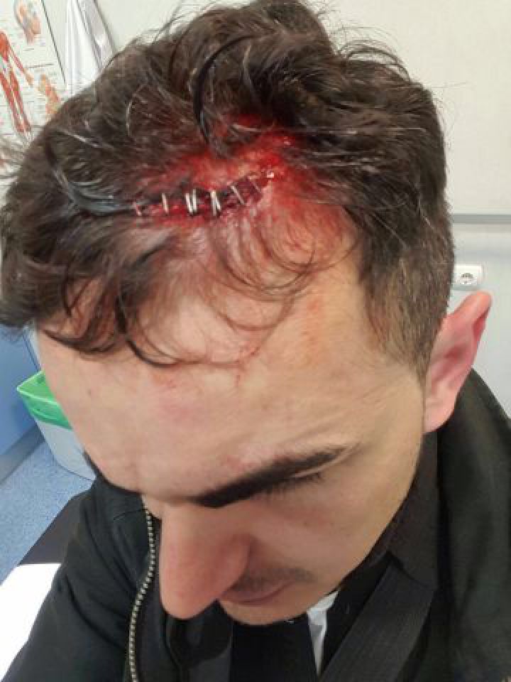 Uno de los agentes heridos en la revuelta registrada en Tetuán. Uno de los agentes heridos en la revuelta registrada en Tetuán.