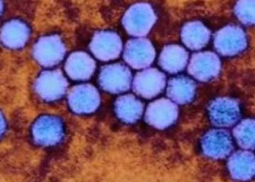 Los niños afectados por el brote de enterovirus ya son 82