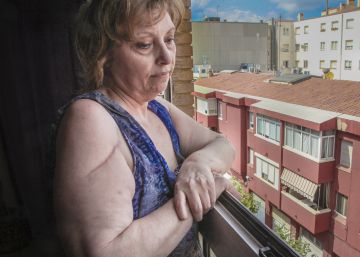 Una mujer lleva un año y medio esperando para una prótesis Una mujer lleva un año y medio esperando para una prótesis