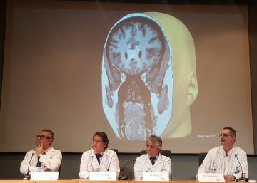 Cirurgia làser al cervell per cremar focus epilèptics