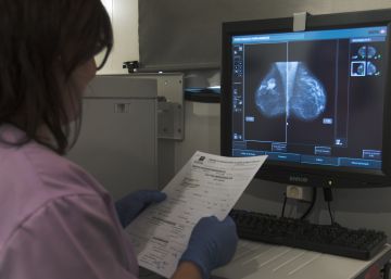 Dos años de espera para una mamografía o una ecografía