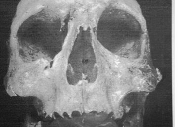 Así murió Bermudo III, el último rey asturleonés