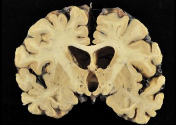 Estudo constata lesões cerebrais em 99% dos ex-jogadores da NFL