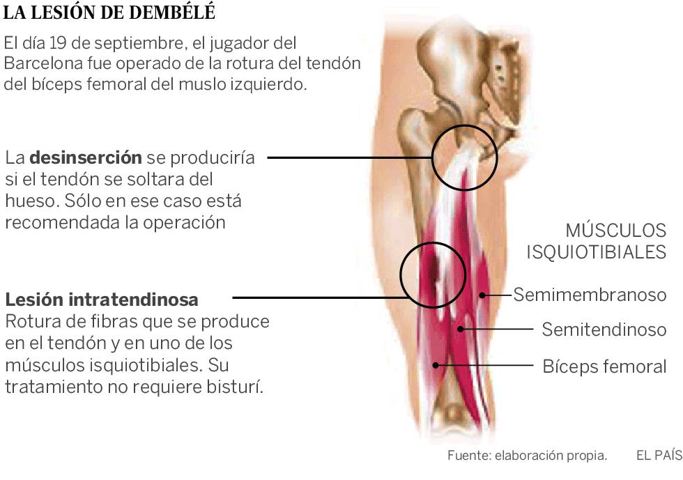 La operación a Dembélé, una excepción en las lesiones de isquios