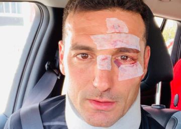 Herido Lionel Scaloni, seleccionador argentino, tras ser atropellado en Mallorca cuando iba en bici