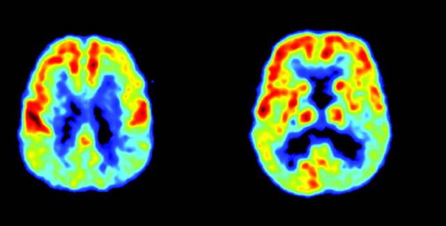 Ese desgraciado alemán que se llama Alzheimer