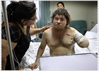 El trabajador boliviano que perdió el brazo recibe el alta