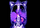 La detección precoz del cáncer de pulmón reduce la muerte un 20%