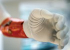Tres pacientes renuncian a una mano inútil a cambio de una biónica
