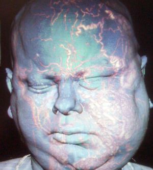 Efectes de la malformació vascular a la cara del pacient.