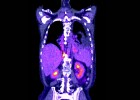 Detectar el cáncer de pulmón pronto eleva la supervivencia al 80%