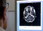 Una punció lumbar per detectar tumors cerebrals
