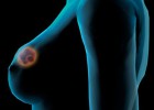 Teste genético reduz em até 14% a quimioterapia em câncer de mama