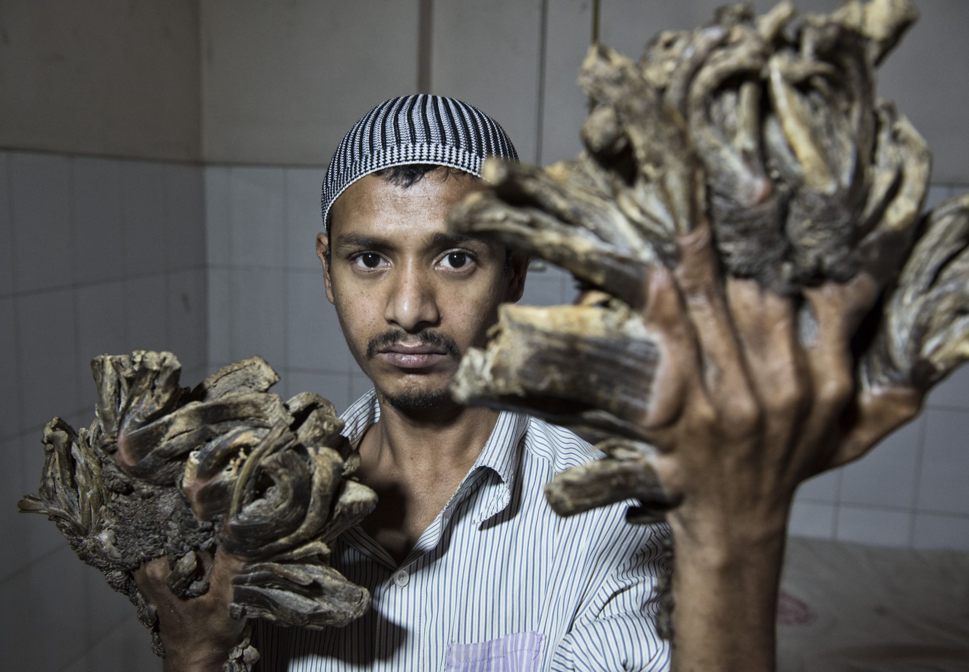 Abul Bajandar é o terceiro caso conhecido do mundo de epidermodisplasia verruciforme, que começou a sofrer há uma década, quando tinha 15 anos. Abul Bajandar é o terceiro caso conhecido do mundo de epidermodisplasia verruciforme, que começou a sofrer há uma década, quando tinha 15 anos.