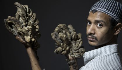 Abul Bajadam muestra sus manos afectadas. Abul Bajadam muestra sus manos afectadas.