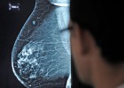 Las guías sobre cáncer infravaloran los riesgos de las pruebas