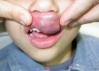 Un posible tratamiento contra el mal que desfigura la cara de niños