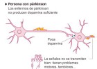 Día Mundial del Párkinson para desmentir los mitos de la enfermedad