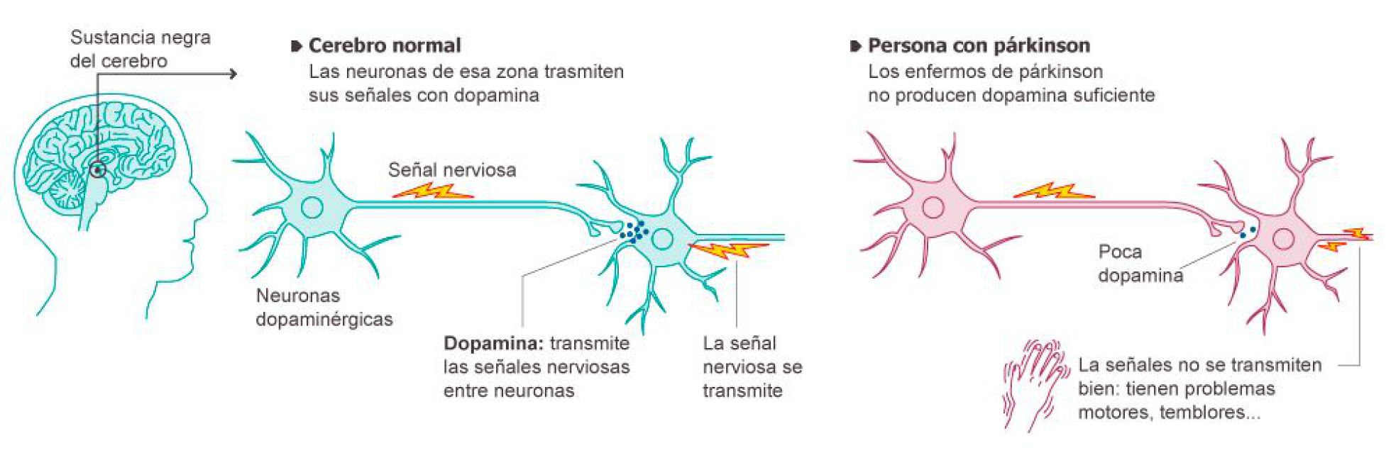 Dia Mundial del Parkinson Dia Mundial del Parkinson