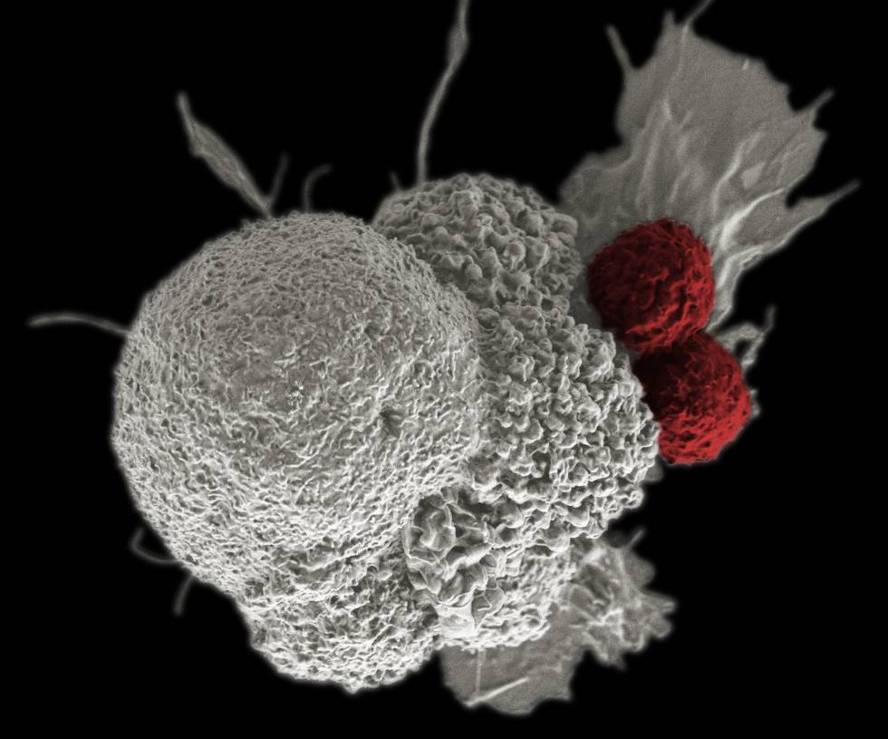 Célula de un cáncer de cabeza y cuello, atacada por dos glóbulos blancos.