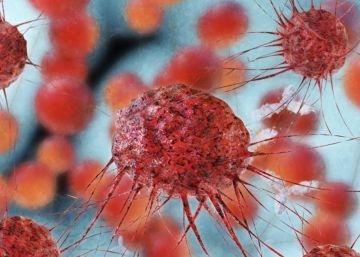 La mortalidad hospitalaria por tumores digestivos cae más del 50% La mortalidad hospitalaria por tumores digestivos cae más del 50%