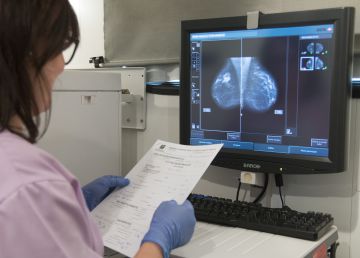 Una ‘bola de cristal’ para predecir el pronóstico de los tumores de mama