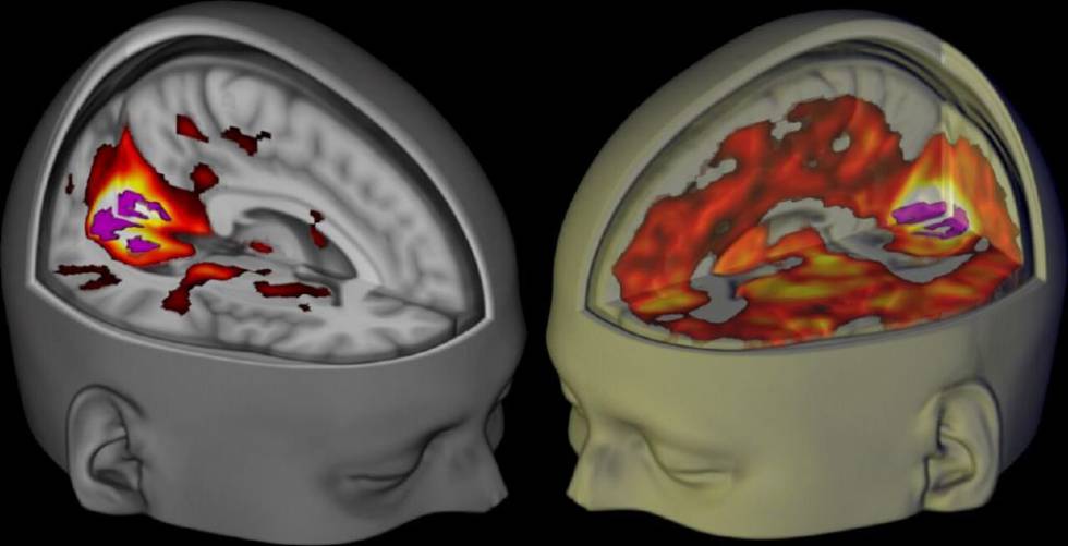 Representación en 3D de un cerebro bajo los efectos del LSD (derecha) y uno en estado normal. Representación en 3D de un cerebro bajo los efectos del LSD (derecha) y uno en estado normal.