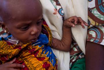 Una niña con malnutrición aguda severa es atendida en el asentamiento informal de Nguel Wanzam de Diffa, Níger.