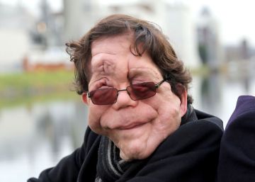 El actor británico Adam Pearson (izquierda), con su hermano gemelo.