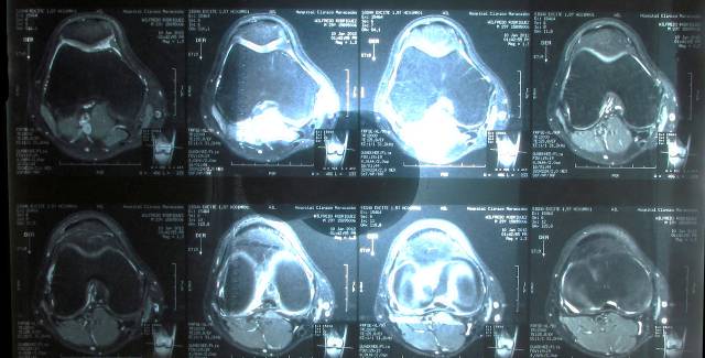 Resonancia magn&eacute;tica de una rodilla.