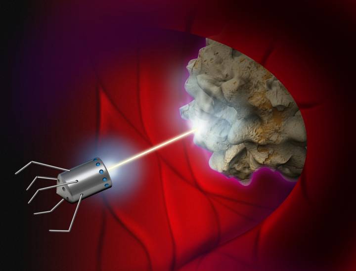 Recreación de un nanorobot destruyendo células cancerígenas. Recreación de un nanorobot destruyendo células cancerígenas.