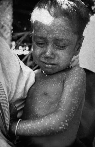 Rahima Banu, la última niña infectada de manera natural de la cepa 'Variola major' de la viruela en Bangladés en 1975.