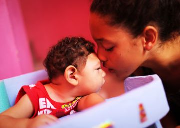 Los efectos visibles del virus del zika en recién nacidos Los efectos visibles del virus del zika en recién nacidos