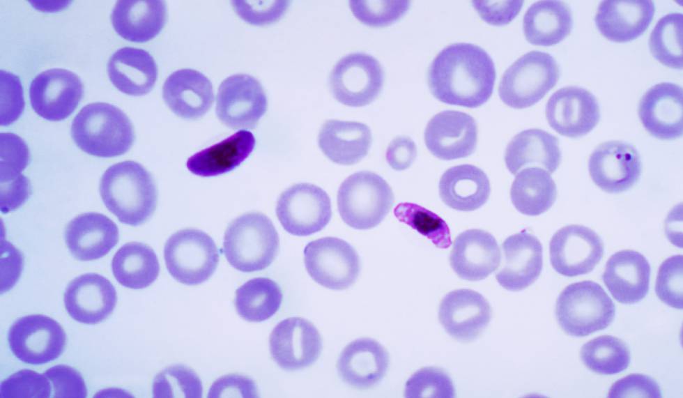 Muestra de sangre que contiene varias formas del parásito de la malaria, 'Plasmodium falciparum'