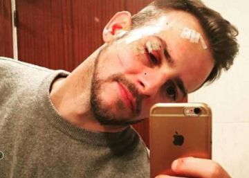 Alex Casademunt, agredido en una discoteca de Vigo