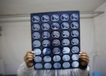 Cómo prevenir millones de muertes por cáncer con lo que ya sabemos