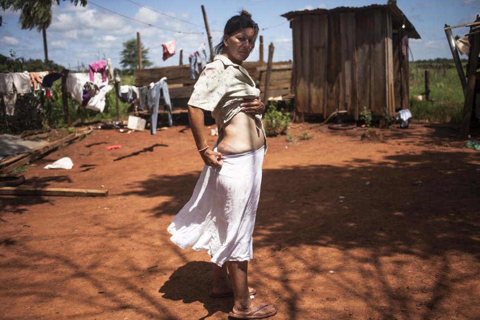 Rosa Agustina, una mujer campesina de Guahory (Paraguay), muestra las heridas de los golpes de la Policía al día siguiente del desalojo.