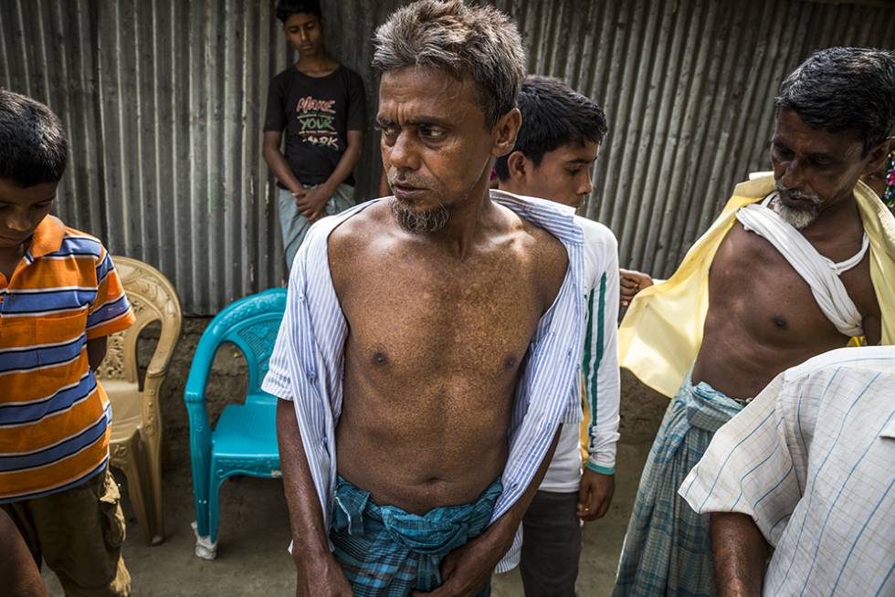 Un hombre muestra su pecho despigmentado, una consecuencia del envenenamiento por arsénico, en la aldea de Merua, Bangladesh