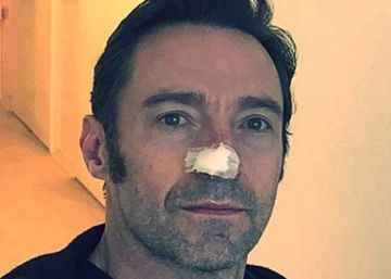 Hugh Jackman confirma sua sexta operação para retirar câncer de pele