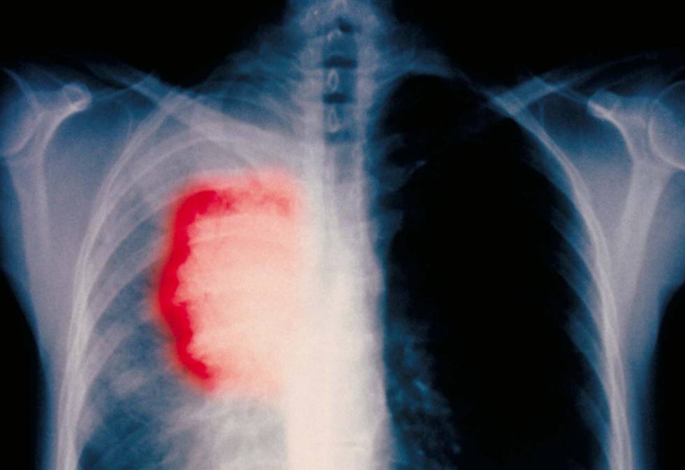 Radiografía de un paciente fumador de 58 años con cáncer de pulmón 