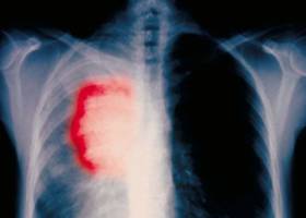 La principal causa del cáncer: el azar