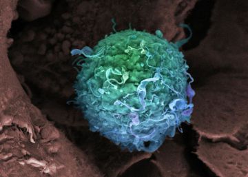 Una célula de cáncer de mama