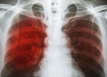 La tuberculosi s’estabilitza
a Barcelona després d’anys de caiguda
