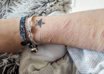¿Por qué los adolescentes se hacen heridas y cortes y suben las fotos en Instagram? ¿Por qué los adolescentes se hacen heridas y cortes y suben las fotos en Instagram?