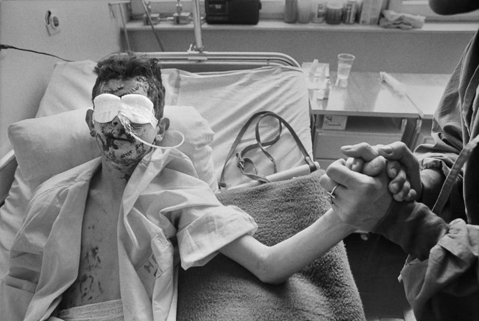 Adis Smajic perdiió su ojo izquierdo y la amputación de su brazo derecho, Sarajevo 1996