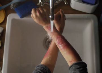La enfermedad que obliga a rascarse todo el rato