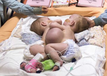Separadas con éxito dos gemelas que nacieron unidas por el pecho en EE UU