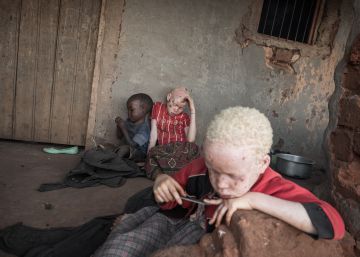 Supersticiones que matan: el tráfico de huesos de albino